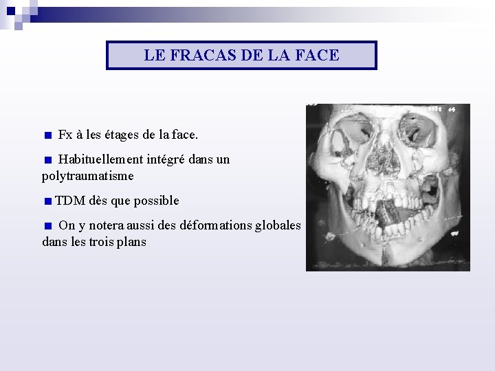 LE FRACAS DE LA FACE Fx à les étages de la face. Habituellement intégré
