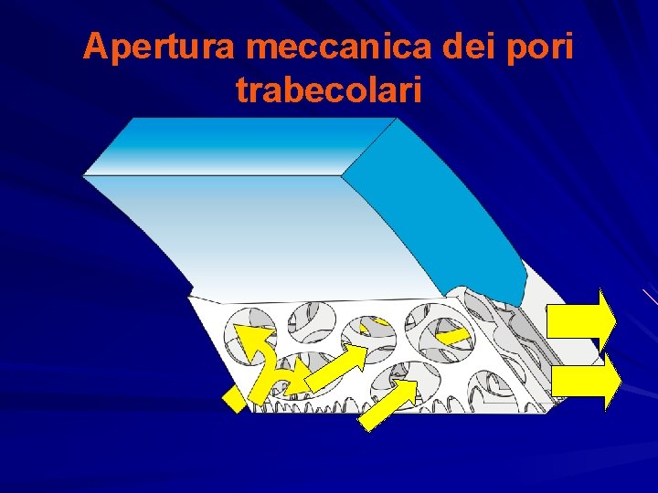 Apertura meccanica dei pori trabecolari 