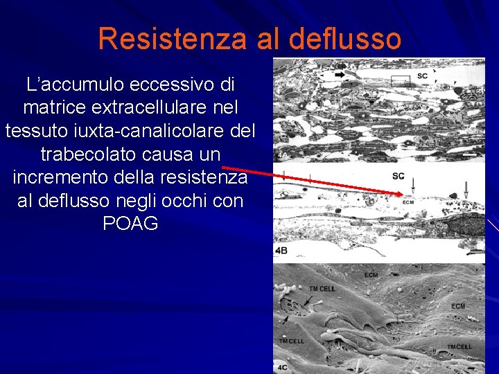 Resistenza al deflusso L’accumulo eccessivo di matrice extracellulare nel tessuto iuxta-canalicolare del trabecolato causa