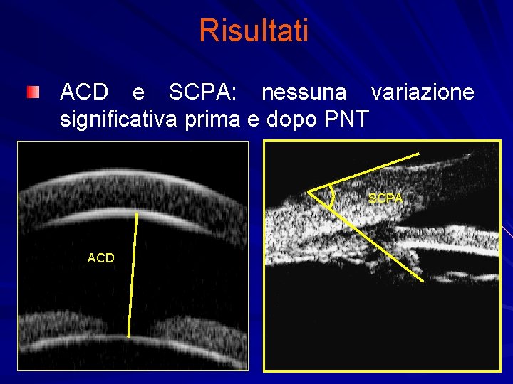Risultati ACD e SCPA: nessuna variazione significativa prima e dopo PNT SCPA ACD 