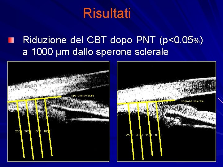 Risultati Riduzione del CBT dopo PNT (p<0. 05%) a 1000 µm dallo sperone sclerale