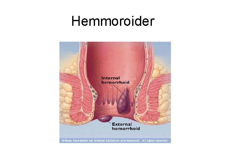Hemmoroider 