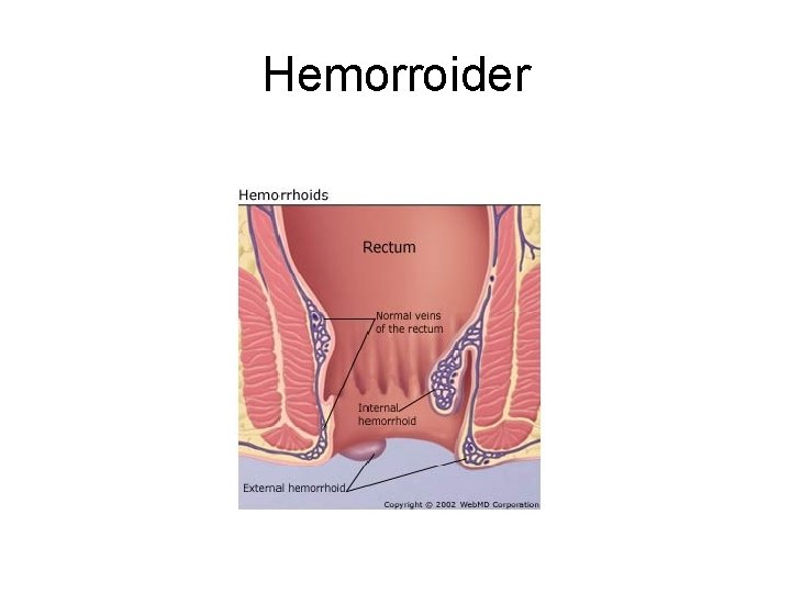 Hemorroider 