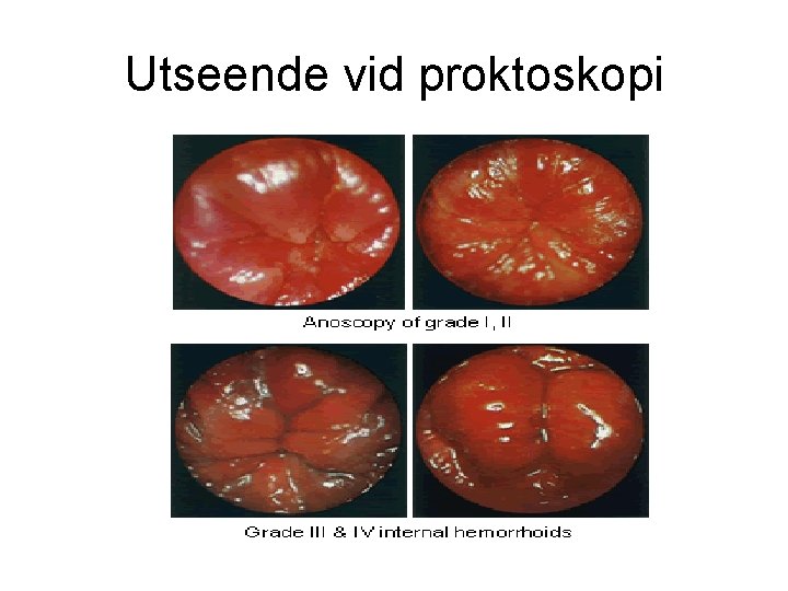Utseende vid proktoskopi 