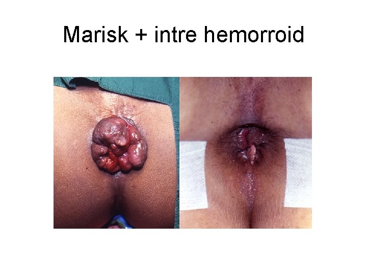 Marisk + intre hemorroid 