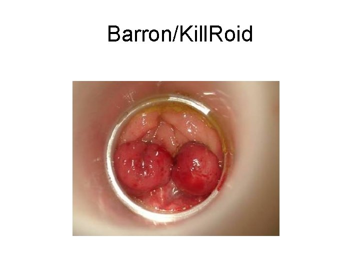 Barron/Kill. Roid 