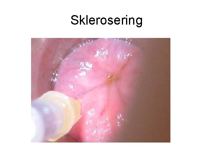 Sklerosering 