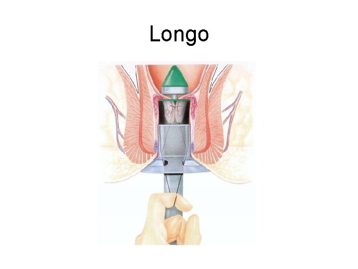 Longo 