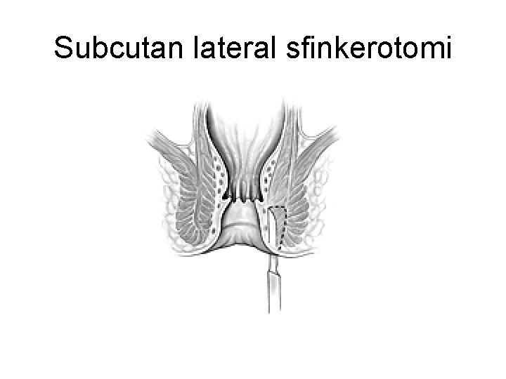 Subcutan lateral sfinkerotomi 