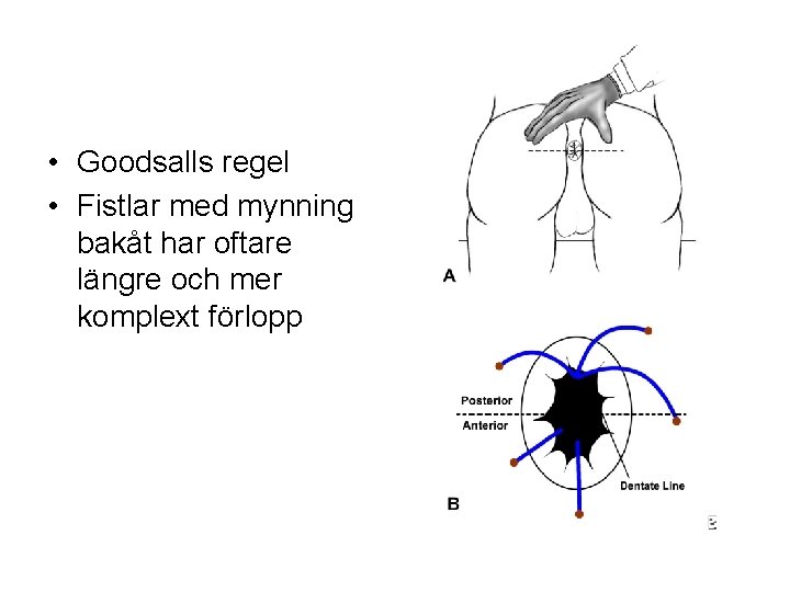  • Goodsalls regel • Fistlar med mynning bakåt har oftare längre och mer