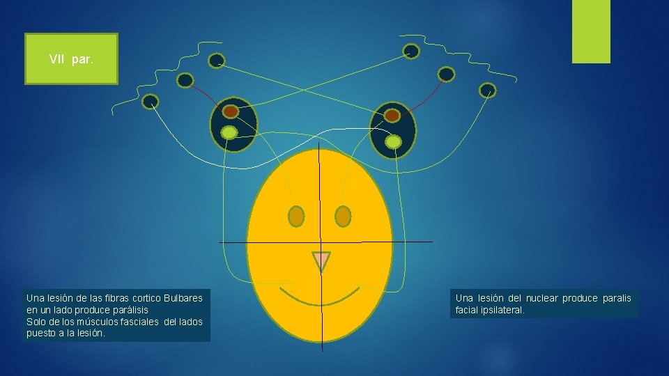 VII par. Una lesión de las fibras cortico Bulbares en un lado produce parálisis