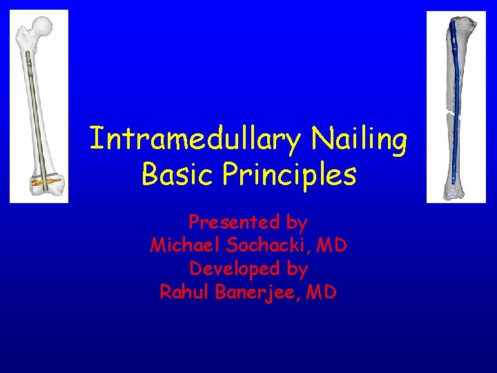 Intramedullary Nailing Basic Principles Presented by Michael Sochacki, MD Developed by Rahul Banerjee, MD