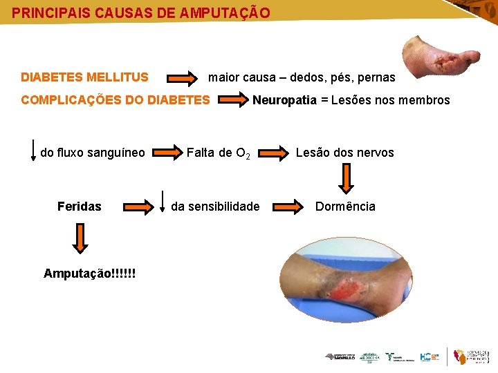 PRINCIPAIS CAUSAS DE AMPUTAÇÃO DIABETES MELLITUS maior causa – dedos, pés, pernas COMPLICAÇÕES DO