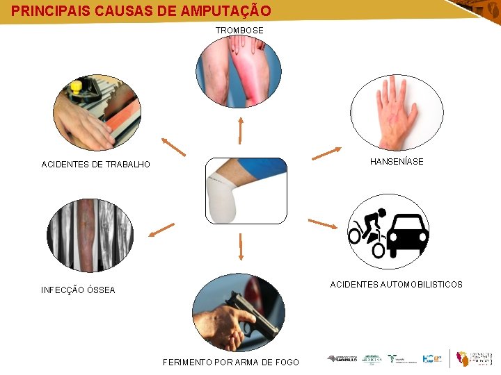 PRINCIPAIS CAUSAS DE AMPUTAÇÃO TROMBOSE HANSENÍASE ACIDENTES DE TRABALHO ACIDENTES AUTOMOBILISTICOS INFECÇÃO ÓSSEA FERIMENTO