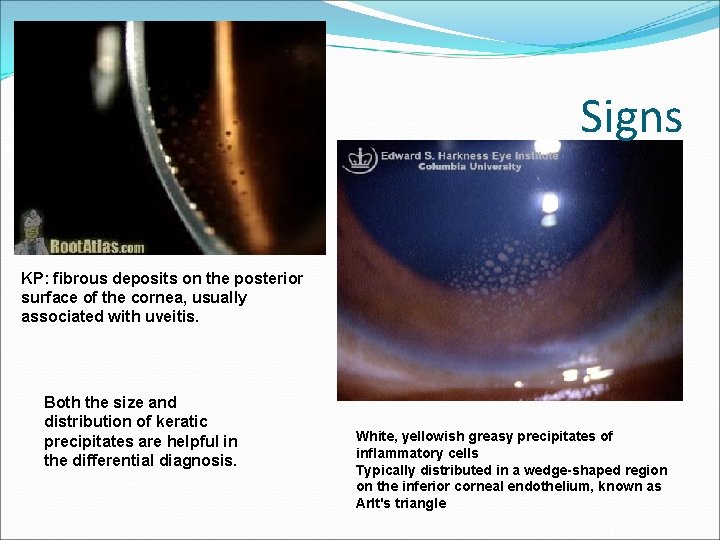 Signs KP: fibrous deposits on the posterior surface of the cornea, usually associated with