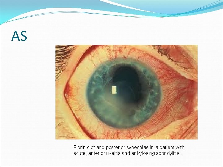 AS Fibrin clot and posterior synechiae in a patient with acute, anterior uveitis and