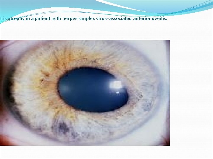 Iris atrophy in a patient with herpes simplex virus–associated anterior uveitis. 