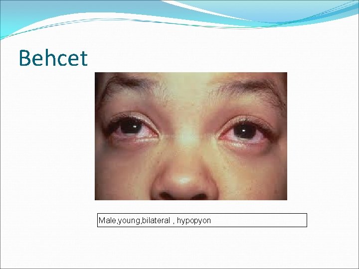 Behcet Male, young, bilateral , hypopyon 