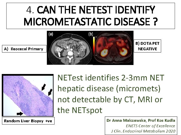 4. CAN THE NETEST IDENTIFY MICROMETASTATIC DISEASE ? A) Ileocecal Primary B) DOTA PET