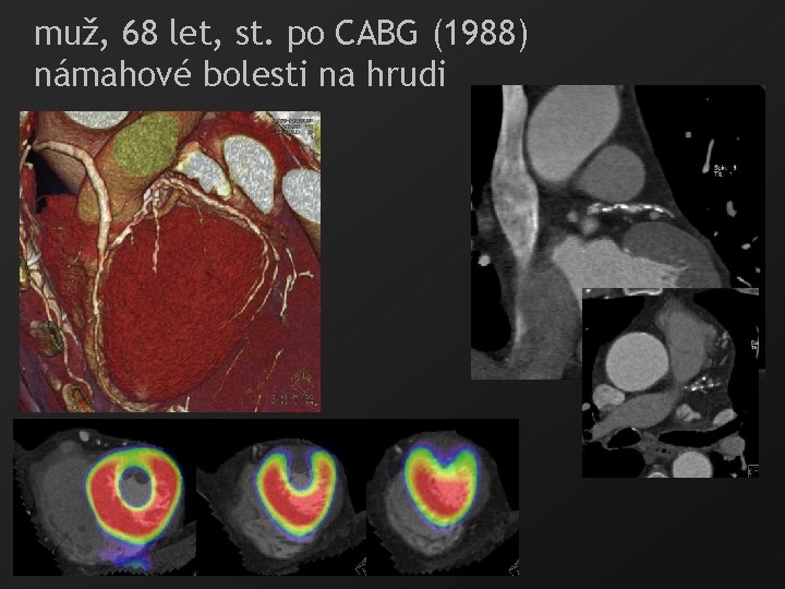 muž, 68 let, st. po CABG (1988) námahové bolesti na hrudi 