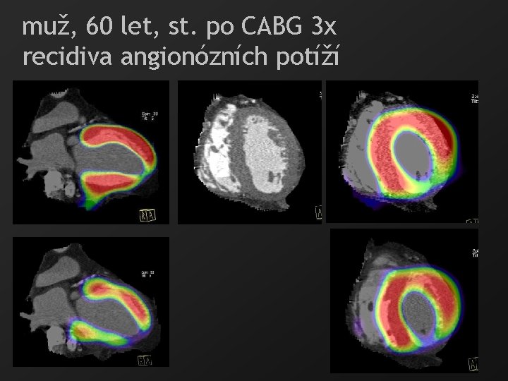 muž, 60 let, st. po CABG 3 x recidiva angionózních potíží 