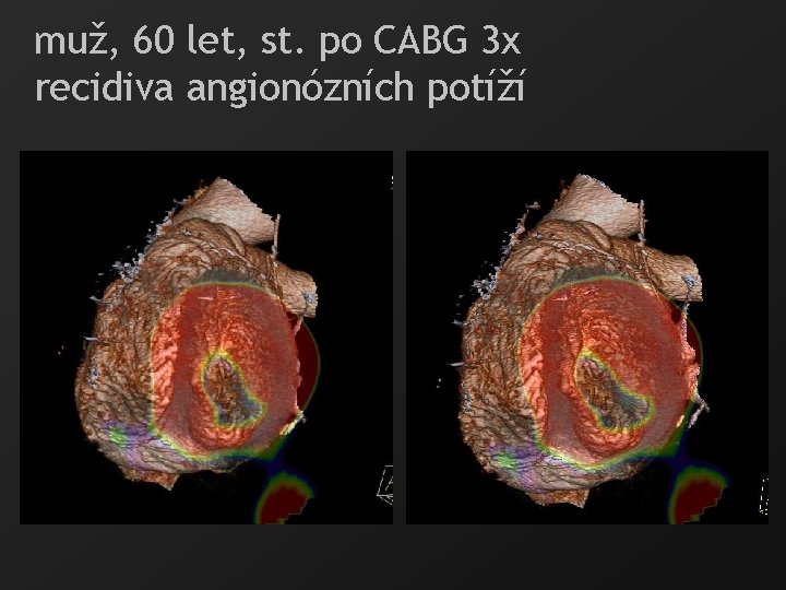 muž, 60 let, st. po CABG 3 x recidiva angionózních potíží 