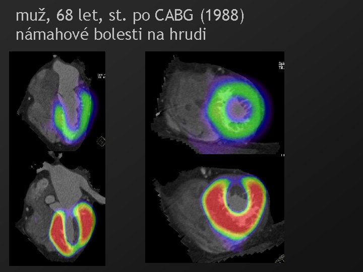 muž, 68 let, st. po CABG (1988) námahové bolesti na hrudi 