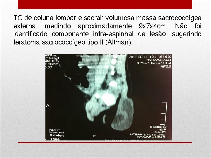TC de coluna lombar e sacral: volumosa massa sacrococcígea externa, medindo aproximadamente 9 x