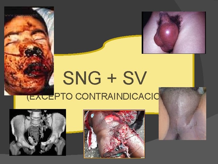 SNG + SV (EXCEPTO CONTRAINDICACIONES) 