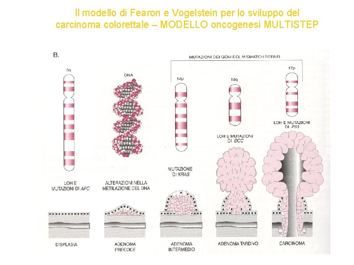 Il modello di Fearon e Vogelstein per lo sviluppo del carcinoma colorettale – MODELLO Il modello di Fearon e Vogelstein per lo sviluppo del carcinoma colorettale – MODELLO