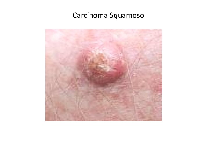 Carcinoma Squamoso Carcinoma Squamoso
