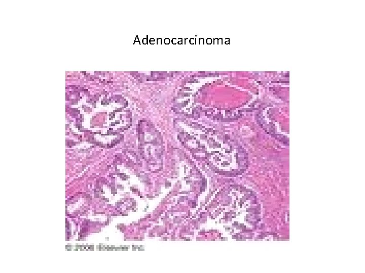Adenocarcinoma Adenocarcinoma