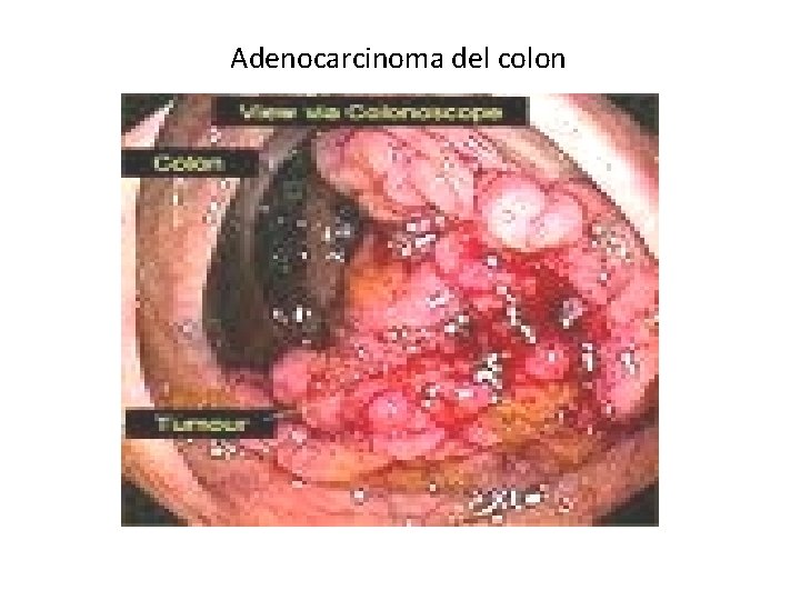 Adenocarcinoma del colon Adenocarcinoma del colon