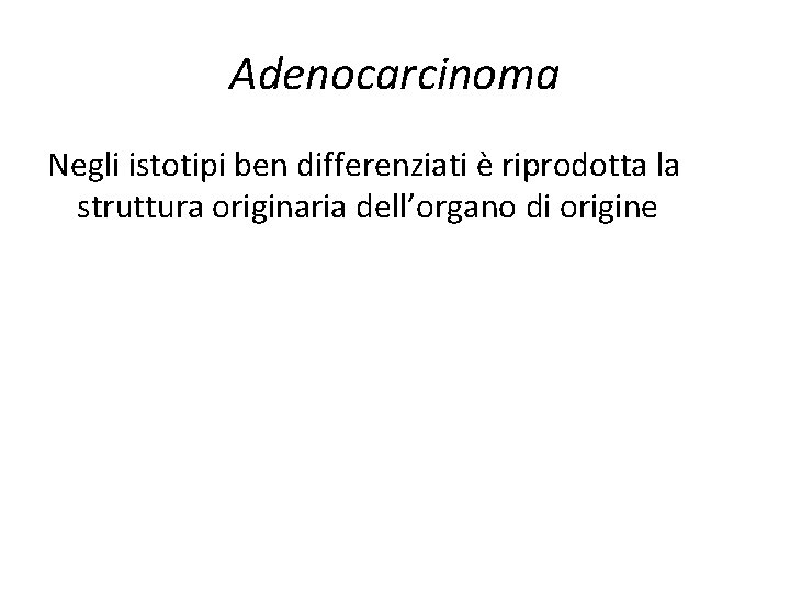 Adenocarcinoma Negli istotipi ben differenziati è riprodotta la struttura originaria dell’organo di origine Adenocarcinoma Negli istotipi ben differenziati è riprodotta la struttura originaria dell’organo di origine