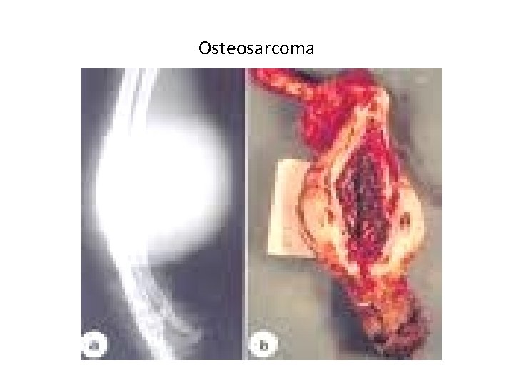 Osteosarcoma Osteosarcoma