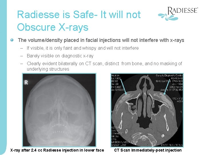 Radiesse is Safe- It will not Obscure X-rays The volume/density placed in facial injections