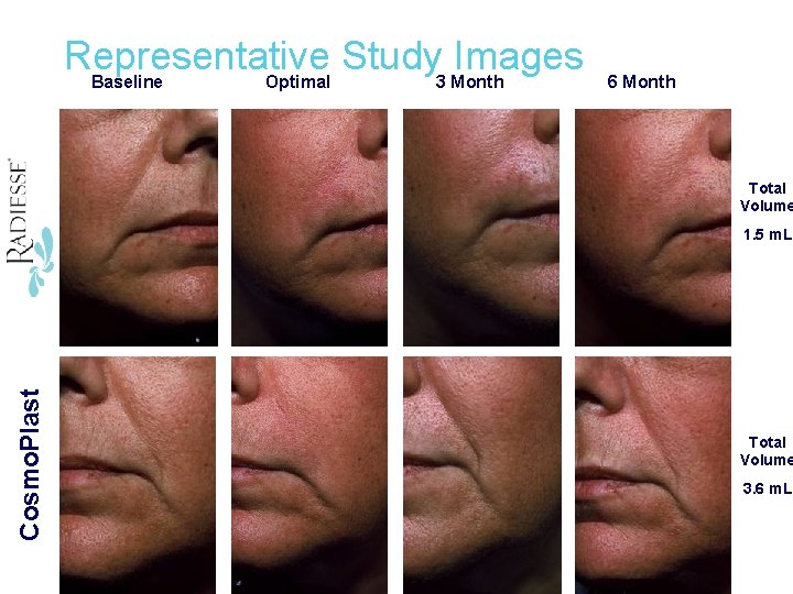 Cosmo. Plast Radiesse Representative Study Images Baseline Optimal 3 Month 6 Month Total Volume