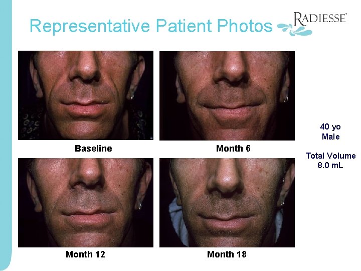 Representative Patient Photos 40 yo Male Baseline Month 12 Month 6 Month 18 Total