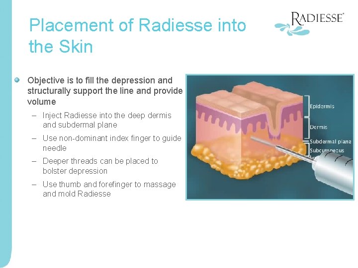 Placement of Radiesse into the Skin Objective is to fill the depression and structurally