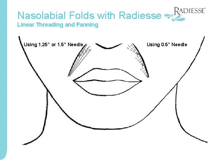 Nasolabial Folds with Radiesse Linear Threading and Fanning Using 1. 25” or 1. 5”