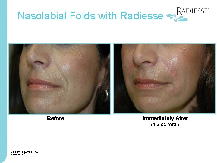 Nasolabial Folds with Radiesse Before Immediately After (1. 3 cc total) Susan Weinkle, MD