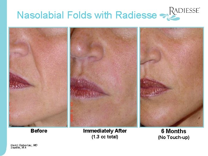 Nasolabial Folds with Radiesse Before Immediately After (1. 3 cc total) Henri Gaboriau, MD