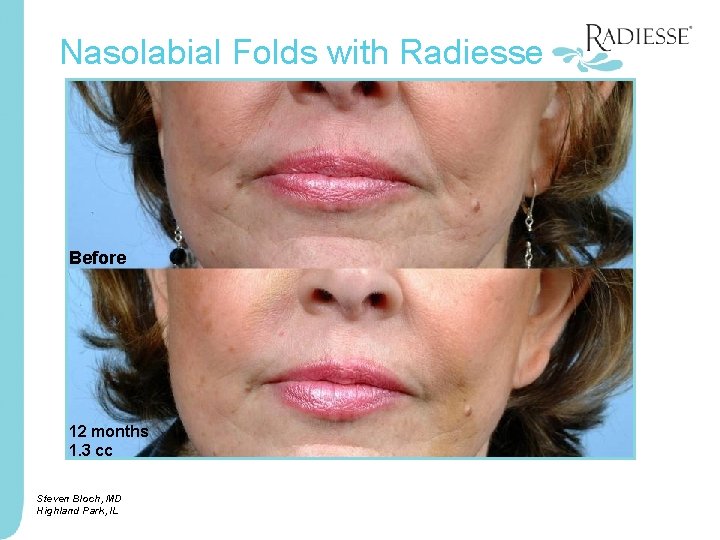 Nasolabial Folds with Radiesse Before 12 months 1. 3 cc Steven Bloch, MD Highland