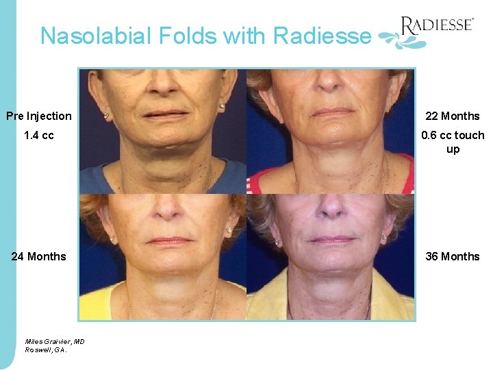 Nasolabial Folds with Radiesse Pre Injection 22 Months 1. 4 cc 0. 6 cc