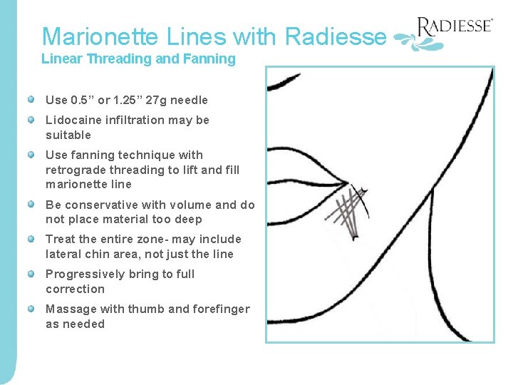 Marionette Lines with Radiesse Linear Threading and Fanning Use 0. 5” or 1. 25”