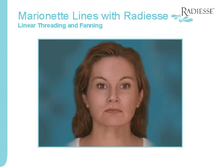 Marionette Lines with Radiesse Linear Threading and Fanning 