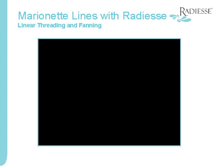 Marionette Lines with Radiesse Linear Threading and Fanning 