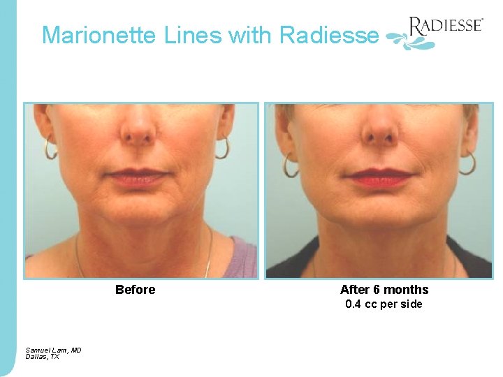 Marionette Lines with Radiesse Before After 6 months 0. 4 cc per side Samuel