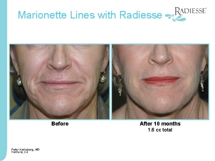 Marionette Lines with Radiesse Before After 10 months 1. 6 cc total Peter Karlsberg,