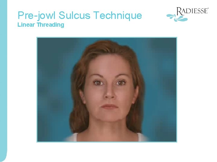 Pre-jowl Sulcus Technique Linear Threading 